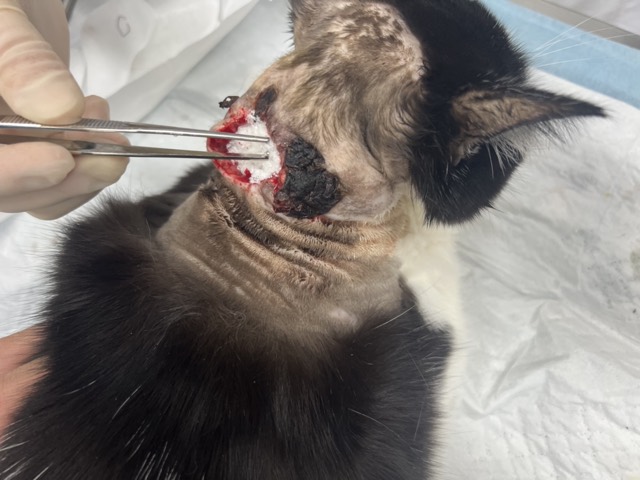 Large-Area Skin-Muscle Separation & Ulceration: Packed then bandaged