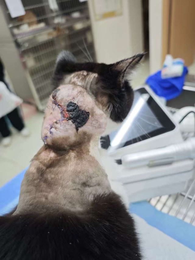 Large-Area Skin-Muscle Separation & Ulceration: Drain placed