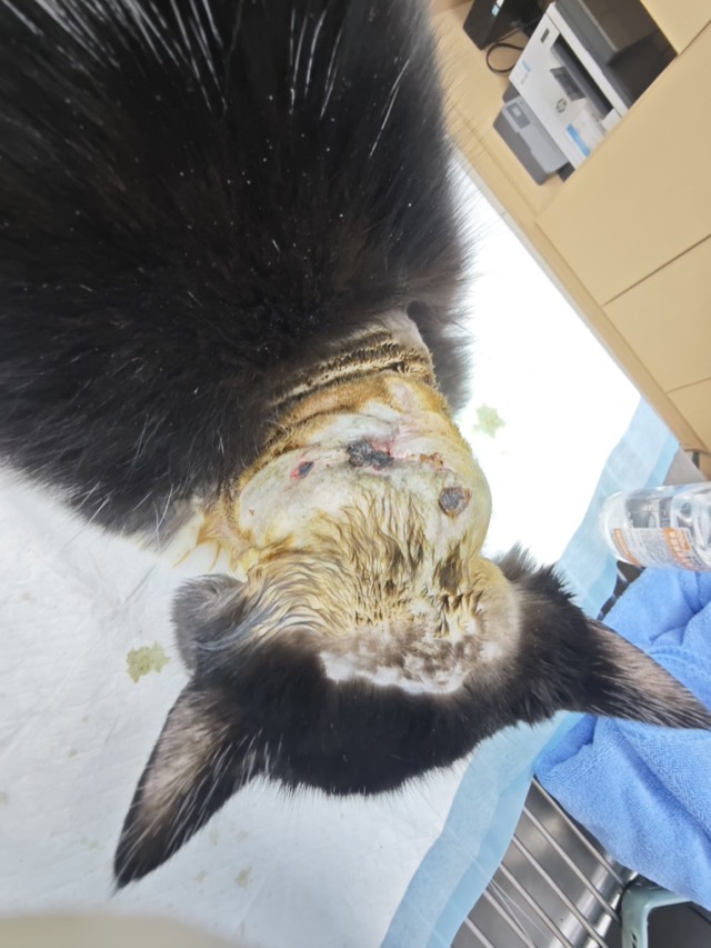 Large-Area Skin-Muscle Separation & Ulceration: Necrotic skin healed, wound closed