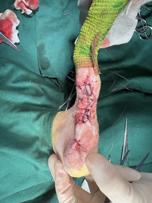 Post-Orthopedic-Surgery Infection: Plate removed, skin flap sutured
