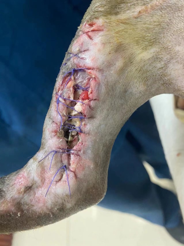 Orthopedic Infection with Soft-Tissue Loss: Bone plate severely exposed