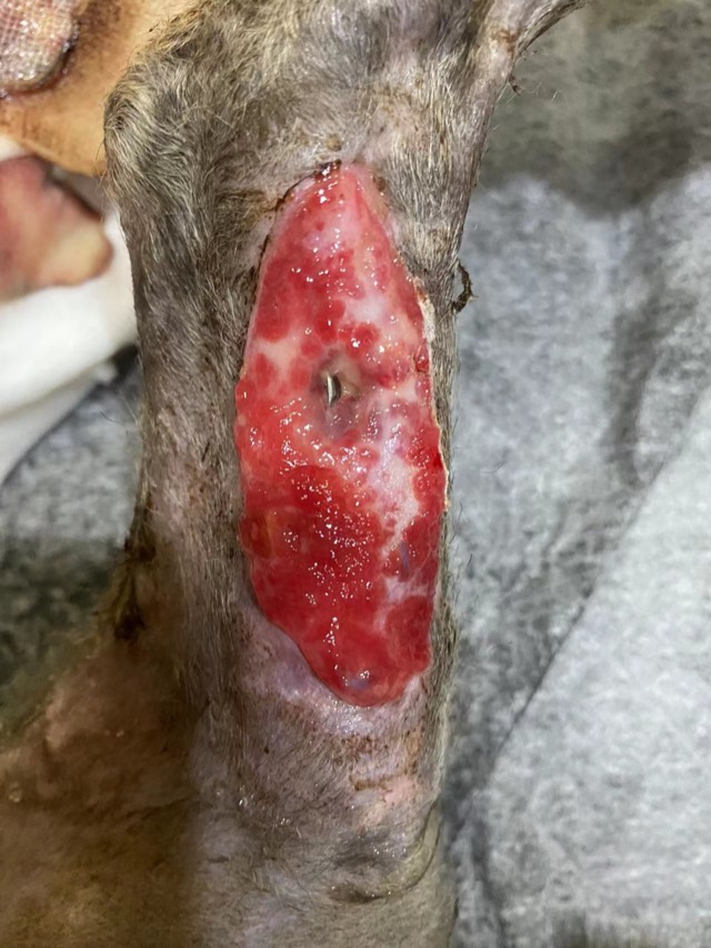 Orthopedic Infection with Soft-Tissue Loss: Granulation envelops bone plate