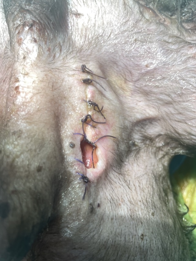 Fat Liquefaction after Bladder-Stone Surgery: Subcutaneous fat liquefaction