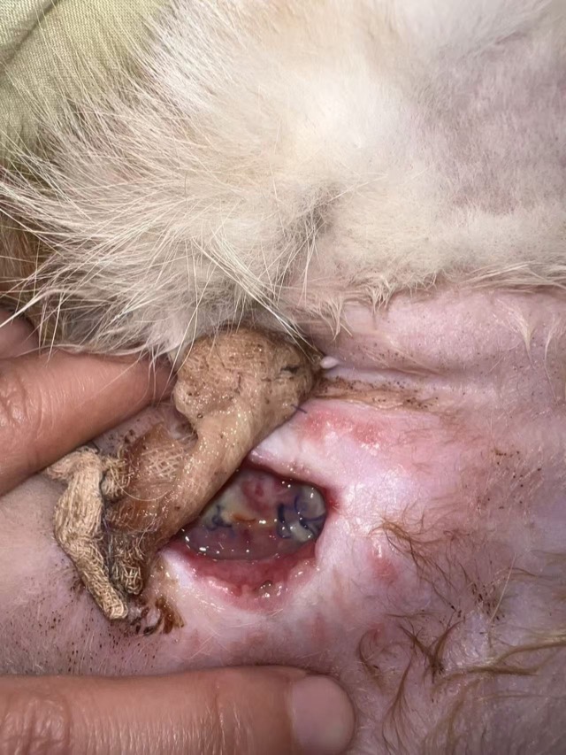Fat Liquefaction after Bladder-Stone Surgery: First ECM Antibacterial Powder application