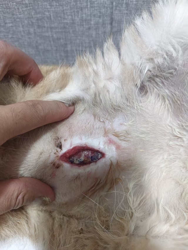 Fat Liquefaction after Bladder-Stone Surgery: Post-op observation