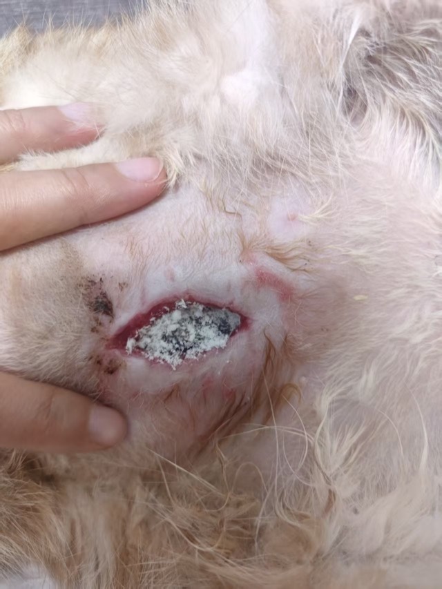 Fat Liquefaction after Bladder-Stone Surgery: Second powder application