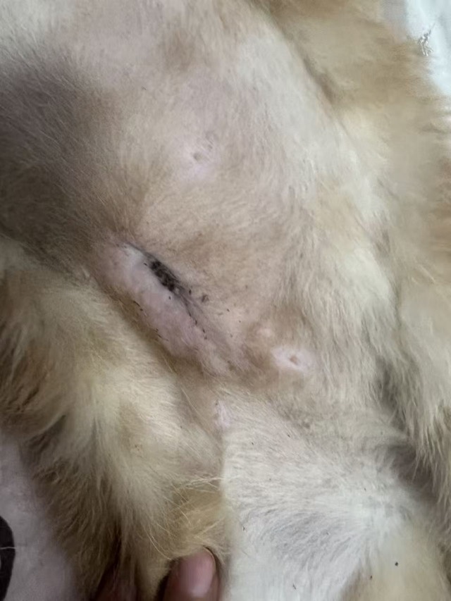 Fat Liquefaction after Bladder-Stone Surgery: Wound consolidated