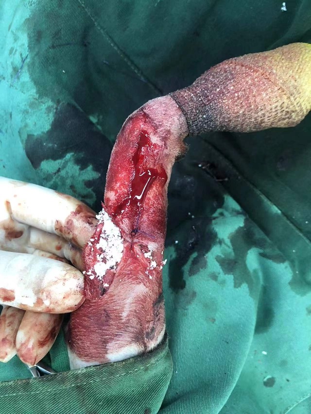 Prophylactic Bite-Wound Application (Subcutaneous Injection): Bite caused large skin-muscle separation