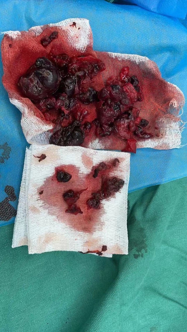 ECM Sponge Assisted Cavity Filling: ECM Sponge soaked in saline