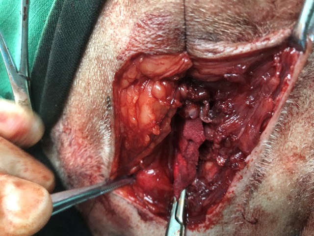 Tumor-Resection Cavity Filling: ECM powder laid subcutaneously