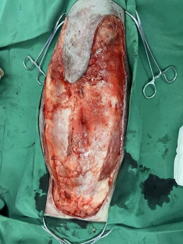 Prophylactic Total Mastectomy Application: ECM powder laid subcutaneously in triangular area