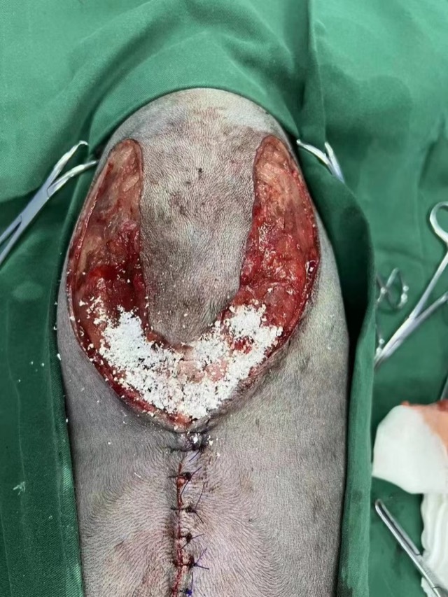 Prophylactic Total Mastectomy Application: ECM Sponge filling in inguinal region