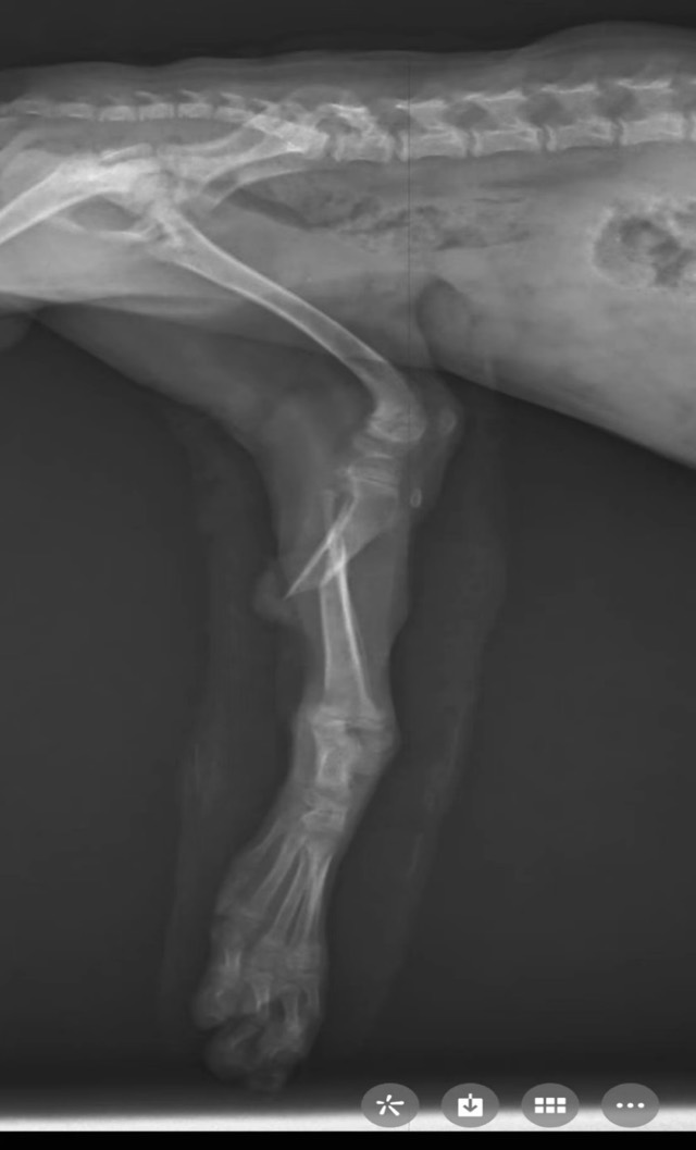 Tibial Oblique Fracture Re-Fracture Revision: First internal fixation