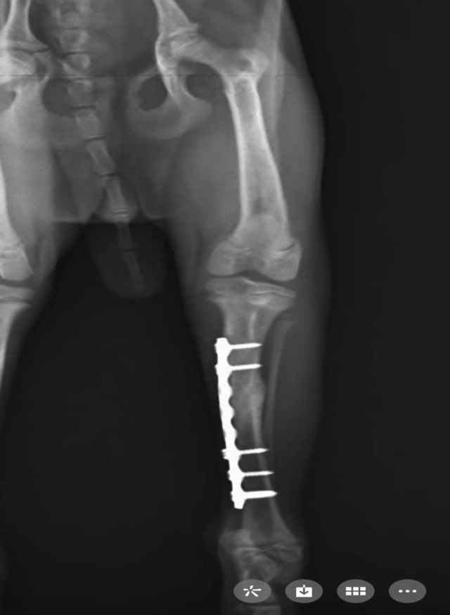Tibial Oblique Fracture Re-Fracture Revision: Plate removed after normal recovery