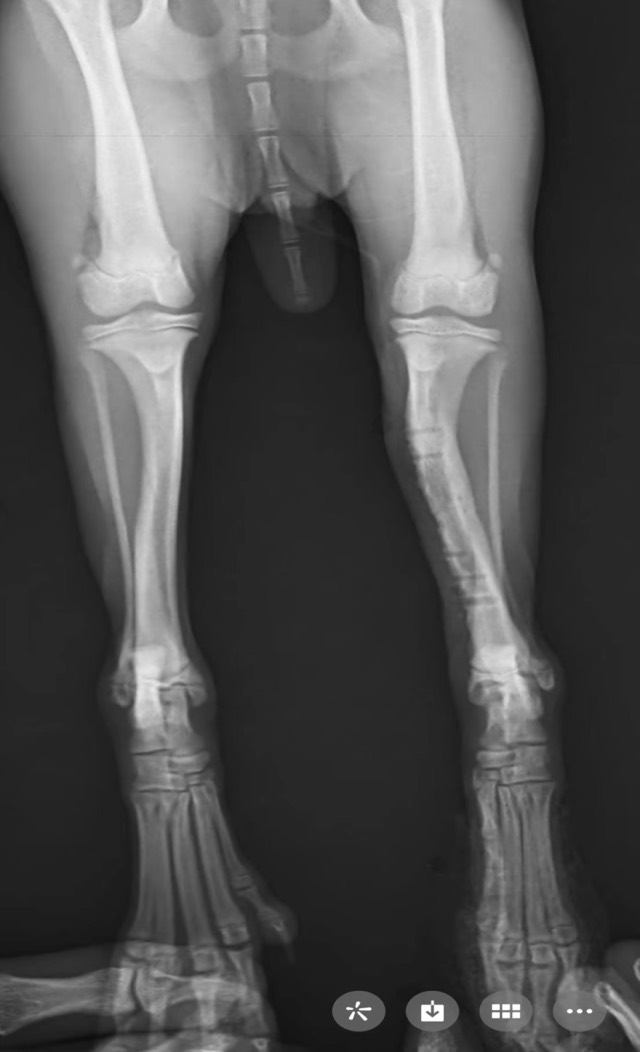 Tibial Oblique Fracture Re-Fracture Revision: Secondary fracture at screw hole