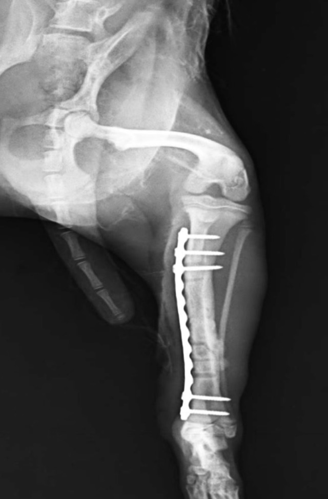 Tibial Oblique Fracture Re-Fracture Revision: Second fixation with Antibacterial Artificial Bone filled
