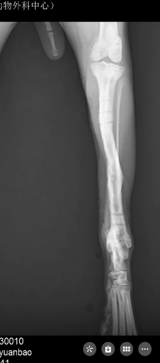 Tibial Oblique Fracture Re-Fracture Revision: Artificial bone packed in screw hole to accelerate osteogenesis