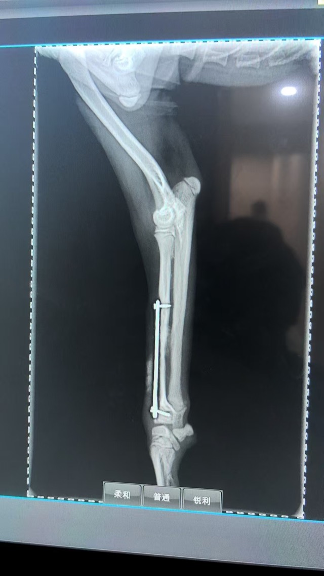 Post-Op Radial/Ulnar Bone Dissolution (Case 2): Artificial bone powder filled