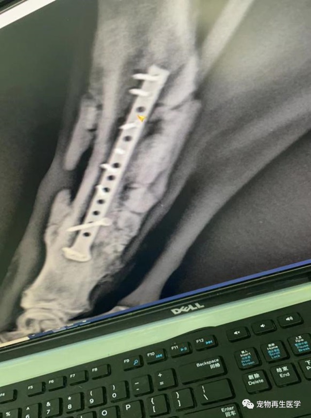 Old Comminuted Fracture Revision: Comminuted, infected fracture