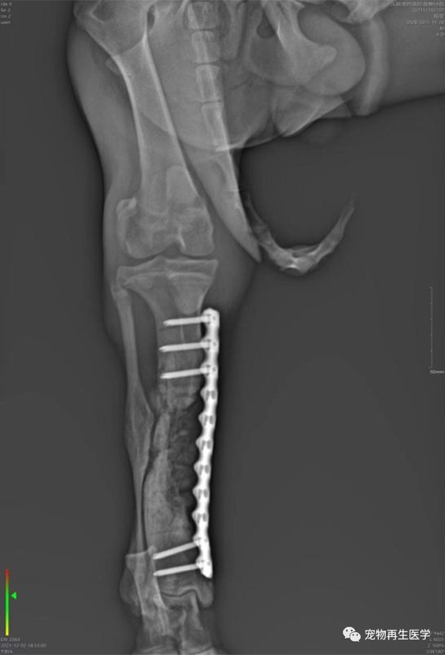 Old Comminuted Fracture Revision: Very large bone defect