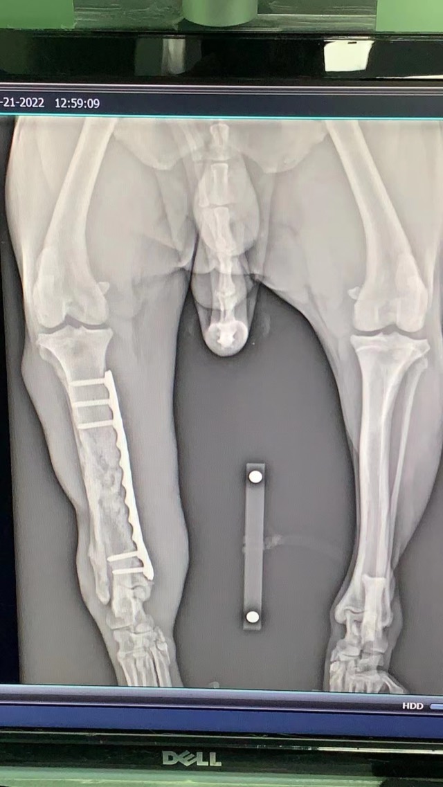 Old Comminuted Fracture Revision: Artificial Bone Plus with periosteal patch