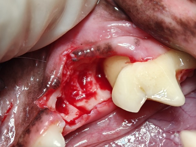 Standard Four Steps of Alveolar Bone Reconstruction: Fig.1 Extraction, curettage