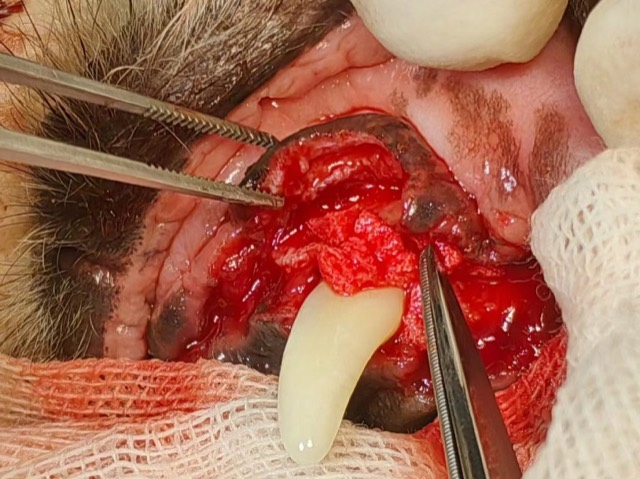 Periodontal GTR Guided Regeneration (Tooth-Saving): Root planing and curettage