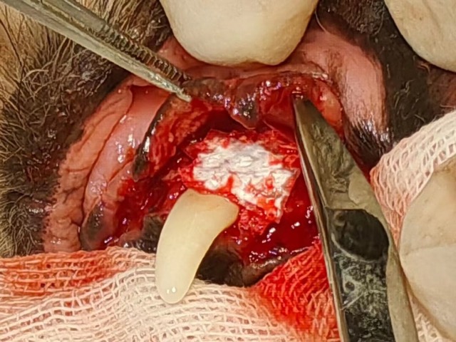 Periodontal GTR Guided Regeneration (Tooth-Saving): Artificial bone packed, Regeneration Barrier Membrane covered
