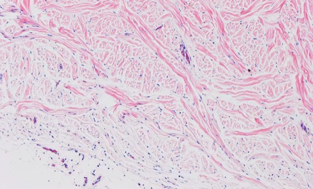 Hernia Mesh Animal Experiment & Pathological Validation: 60-day pathology: fibroblasts infiltrated, no inflammation