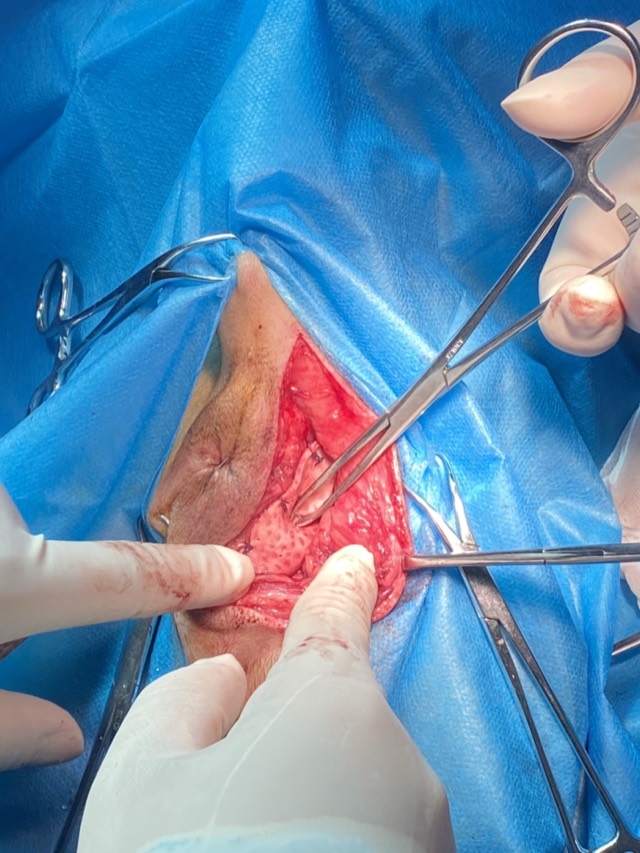 Perineal Hernia Repair: Hernia mesh repair