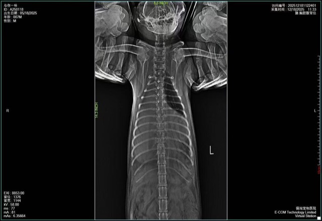Diaphragmatic Hernia Repair: Defect measured, custom mesh cut