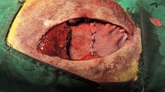 Thoracic Cavity Repair: Mesh pieced to repair bite holes