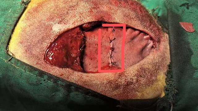 Thoracic Cavity Repair: Mesh overlaid at seam for reinforcement