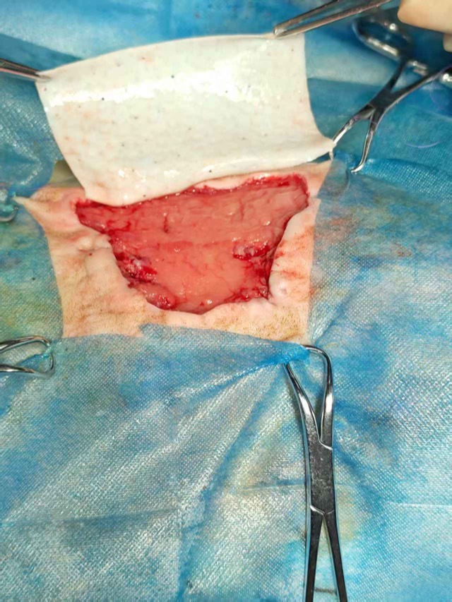 Artificial Skin for Skin-Defect Repair: Surgery day