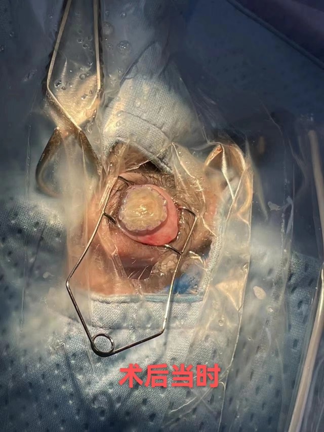 Corneal Patch Transplantation: Corneal patch application