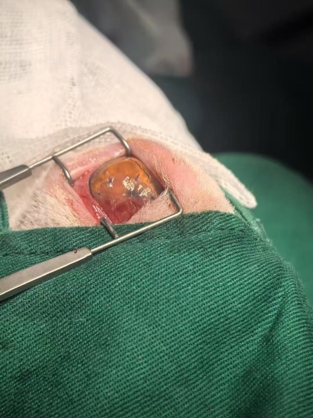Corneal Patch Transplantation: Corneal growth very good