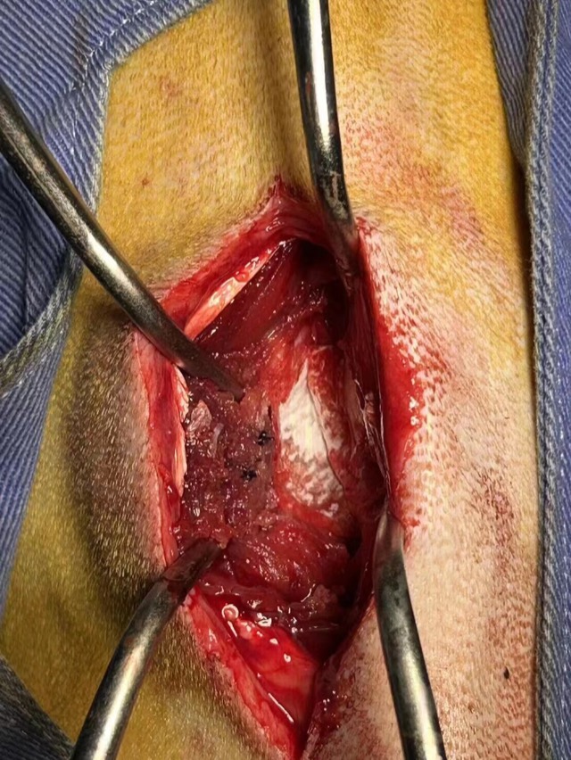Hemilaminectomy (Disc Fenestration): ECM membrane sheet applied