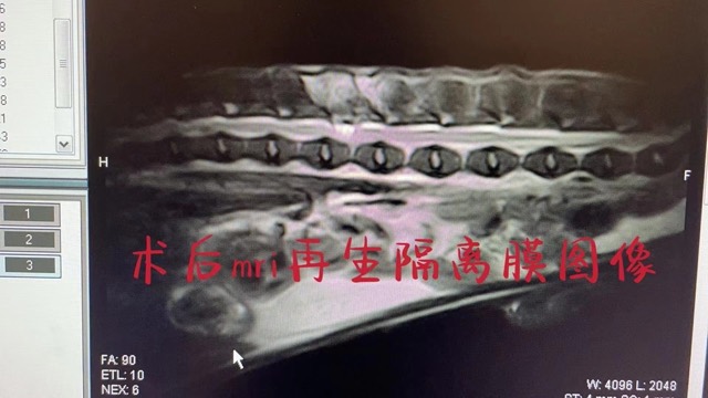 Hemilaminectomy (Disc Fenestration): Post-op